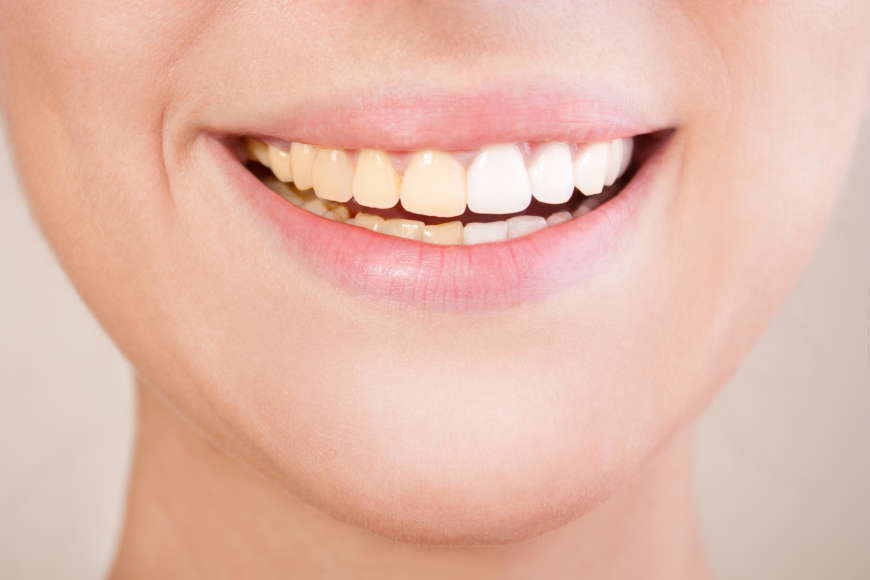 Dental Health and Tooth Discoloration Dental Health and Tooth Discoloration